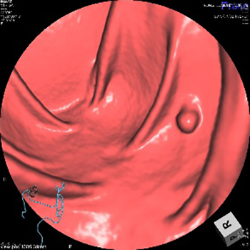 大腸CT（CTC）画像